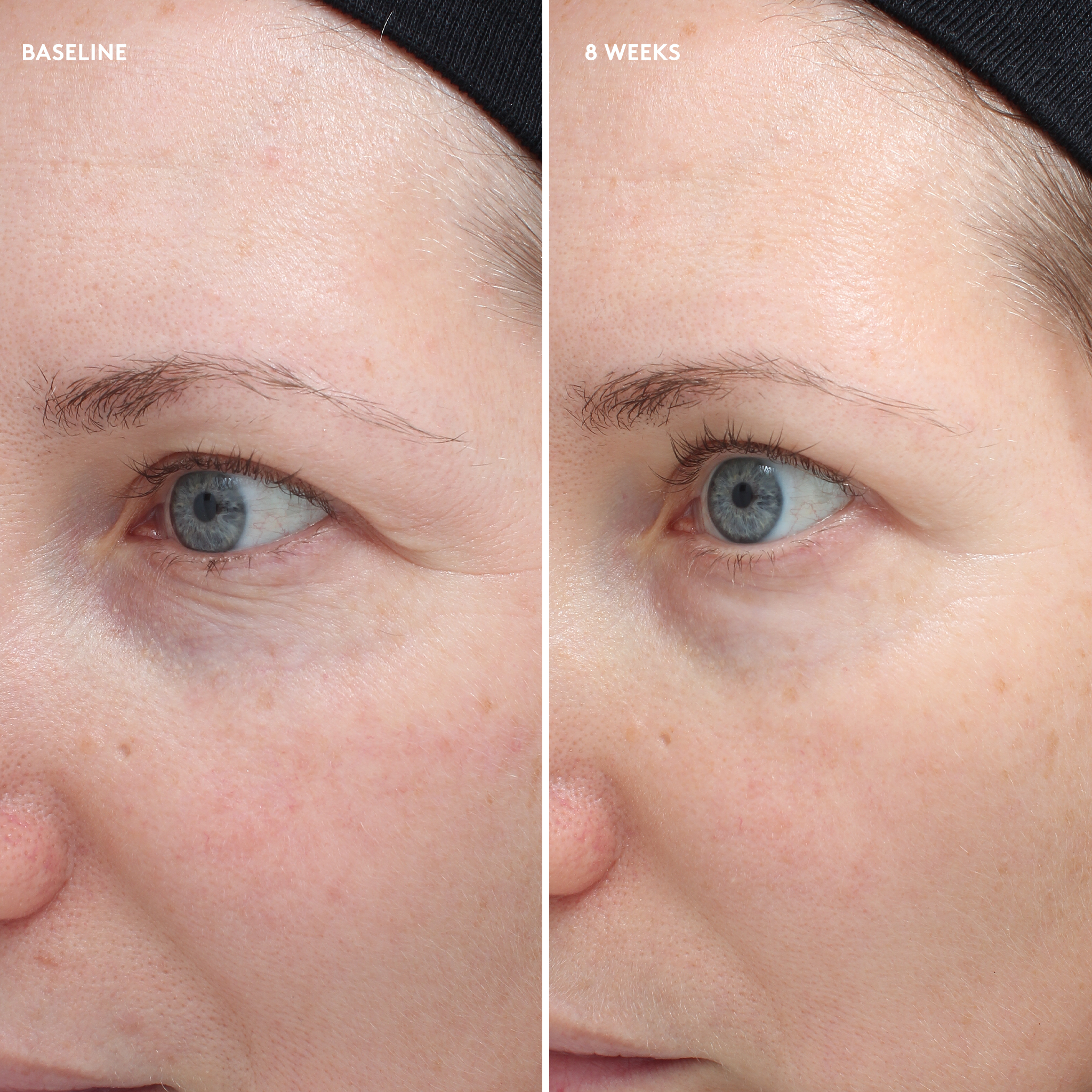 before and after of woman's eyes at baseline and week 8 || all